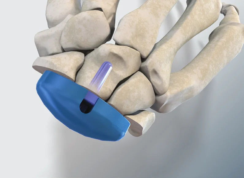 Carpal Poly Trial
