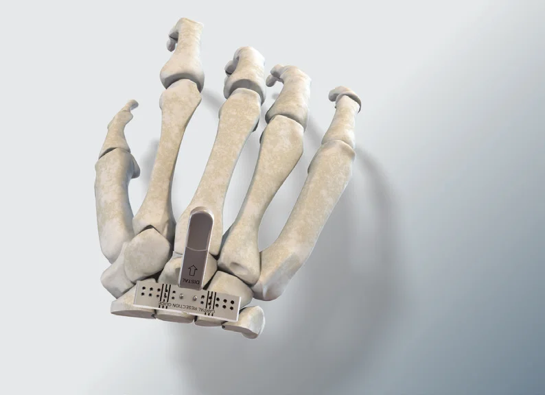 Carpal Resection Guide