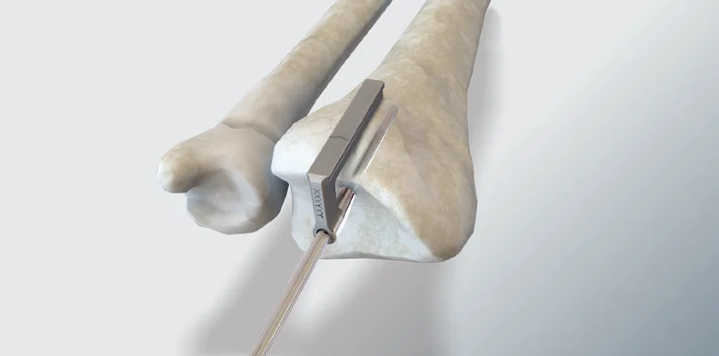 Radial Feeler