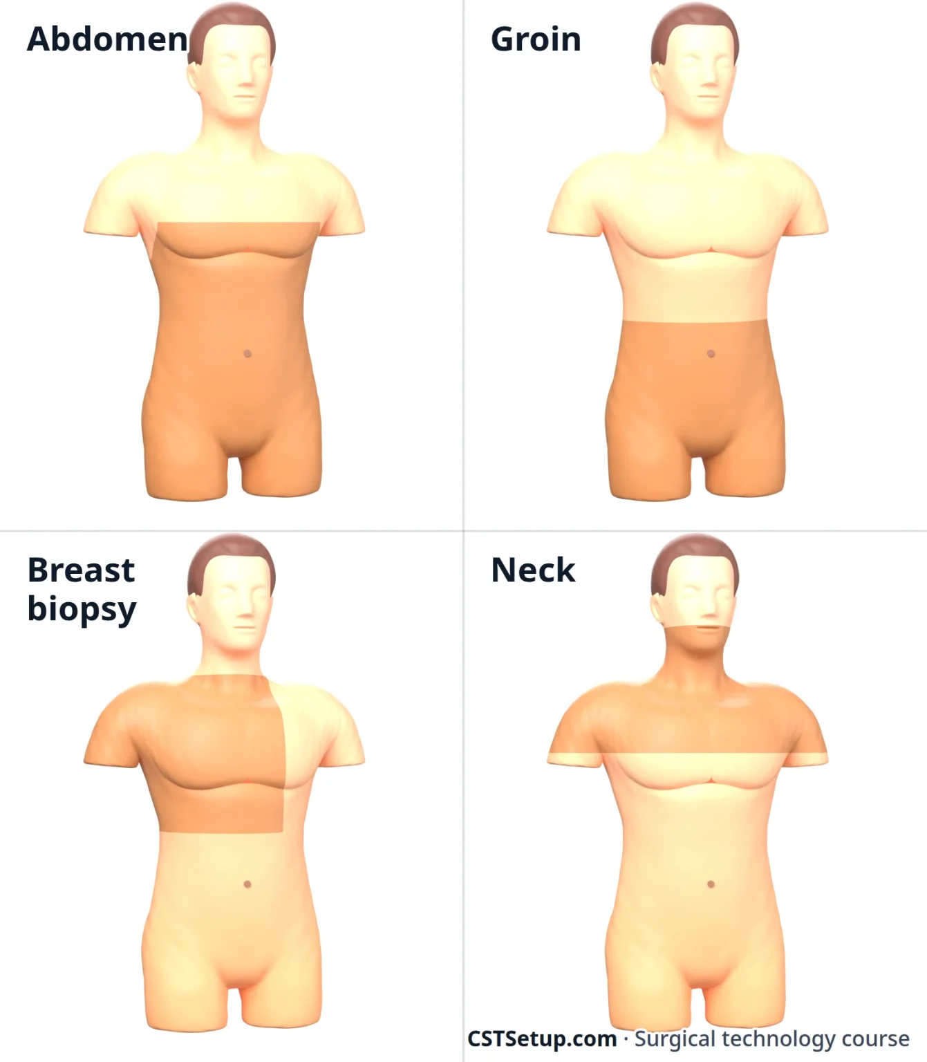 The prep areas, shaded, for the abdomen, groin, breast and neck.