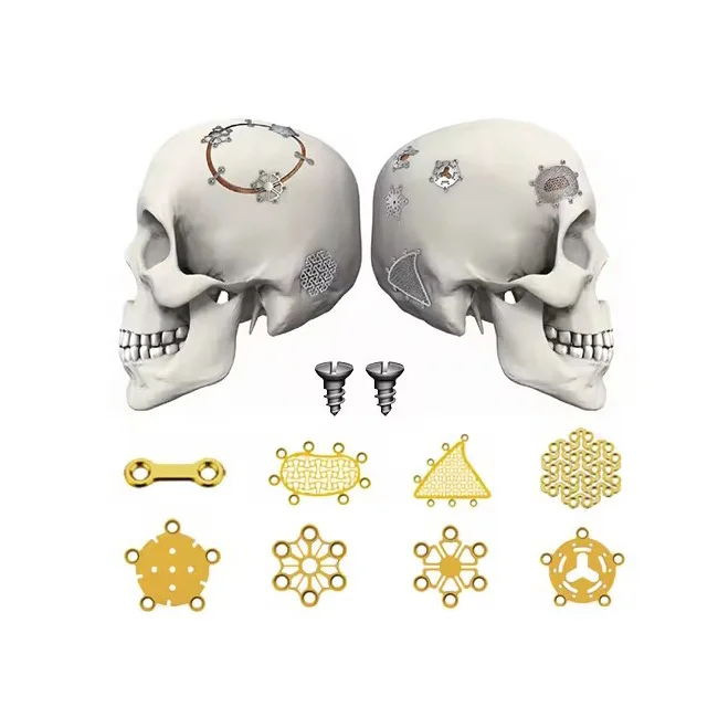 Plates and Screws