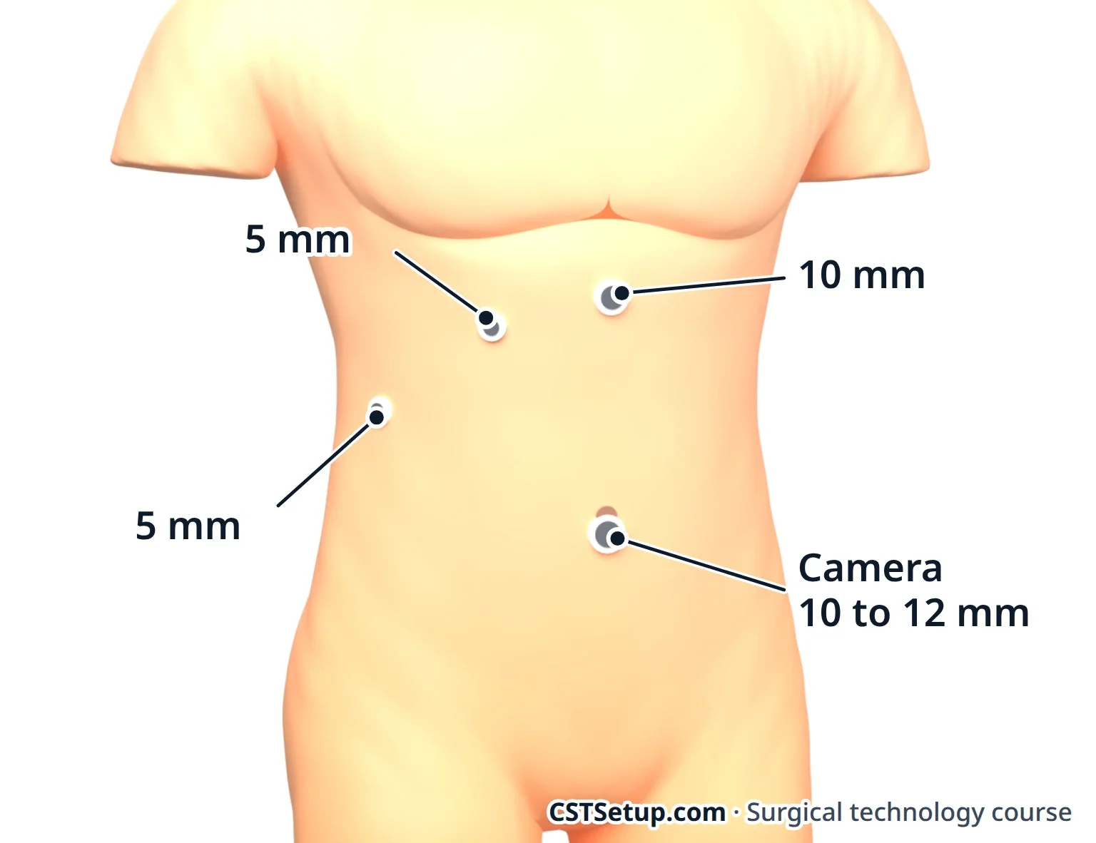 Port sites for a laparoscopic cholecystectomy: the camera at the umbilicus, one high in the midline, and two 5 mm ports below the right ribs.