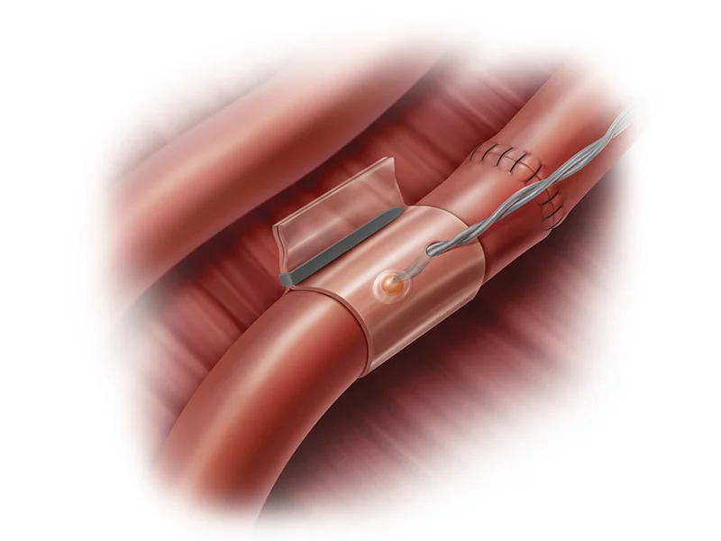 Implantable Doppler Probe